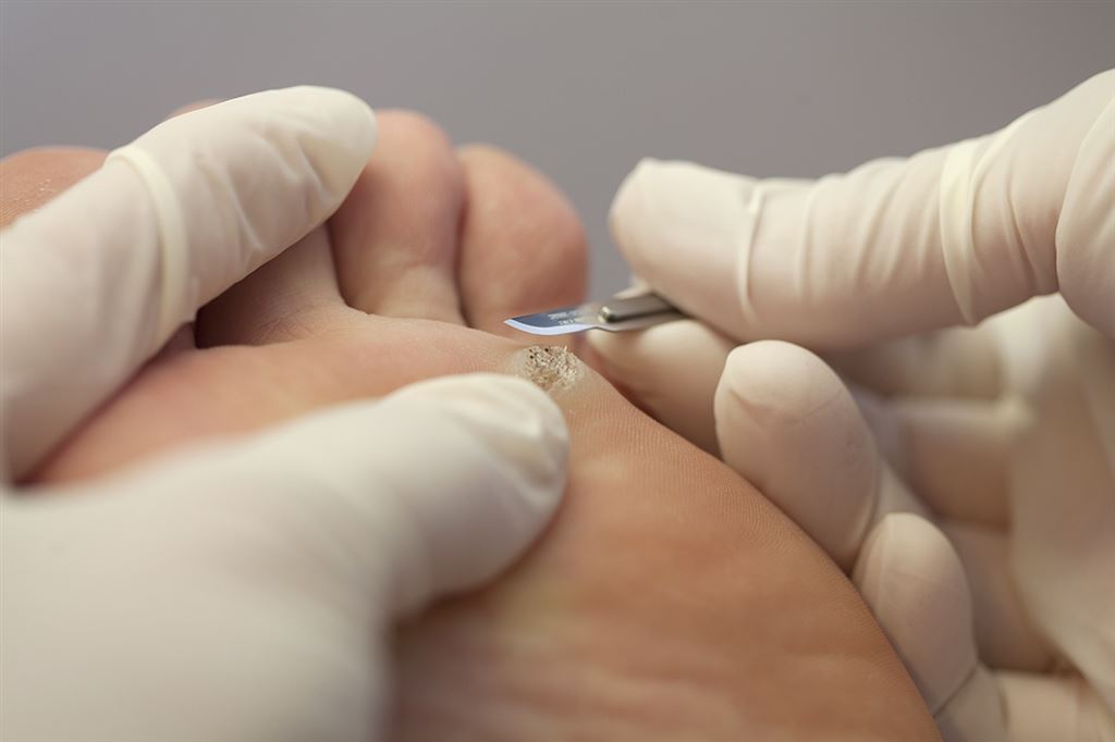 Beskæring af fodvorte