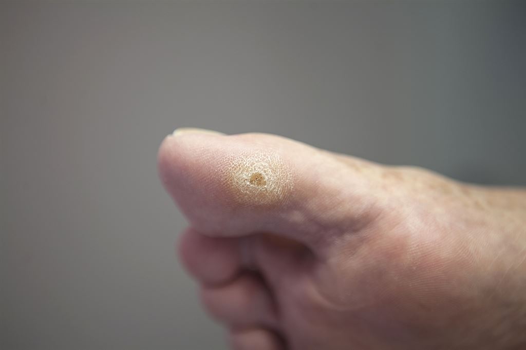 Hård hud på storetå