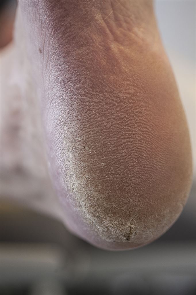Hård hud på hæl